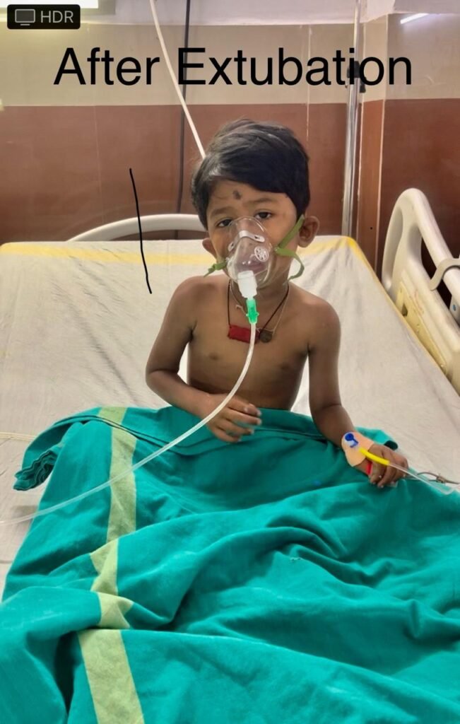 रायगढ़: करैत के डसने से मरणासन्न मासूम को मेडिकल कॉलेज हॉस्पिटल में मिला नया जीवन .. Kshiti Technologies रायगढ़: करैत के डसने से मरणासन्न मासूम को मेडिकल कॉलेज हॉस्पिटल में मिला नया जीवन .. Kshiti Technologies